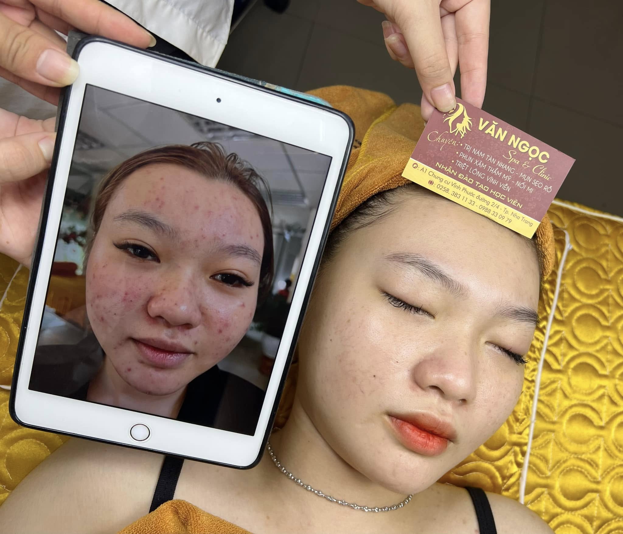 Hình ảnh nền da cần chăm sóc mụn và phục hồi tại Văn Ngọc Spa