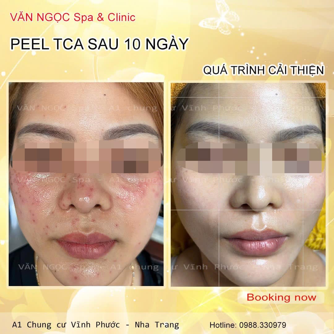 Hình ảnh nền da sau giai đoạn phục hồi tại Văn Ngọc Spa