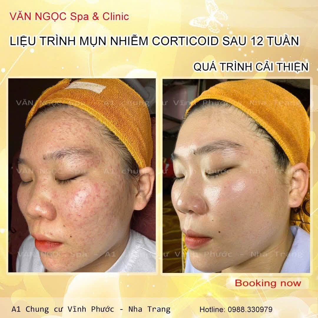 Hình ảnh theo dõi làn da trong liệu trình chăm sóc da tại Văn Ngọc Spa