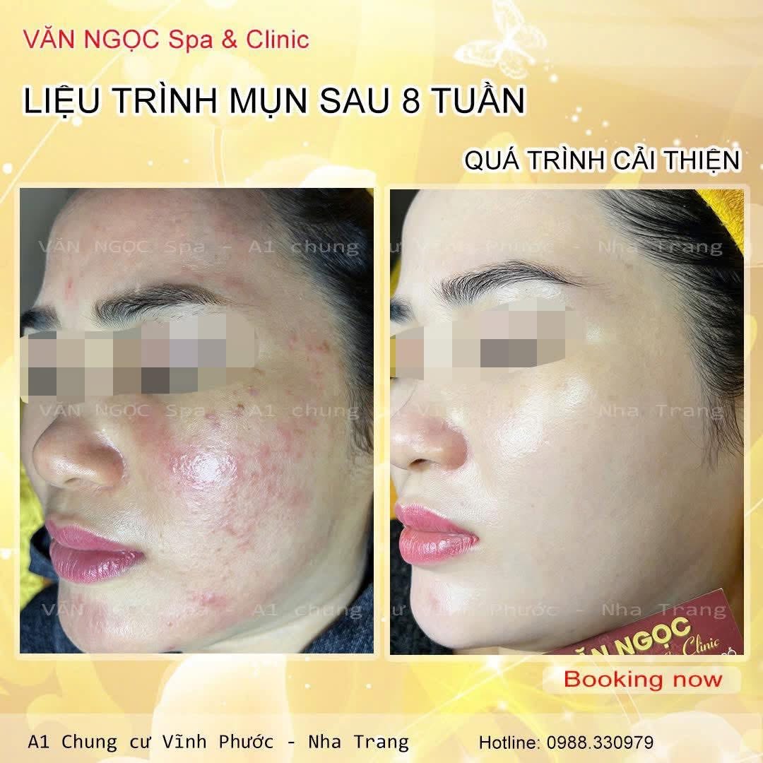 Hình ảnh theo dõi làn da trong liệu trình chăm sóc da tại Văn Ngọc Spa