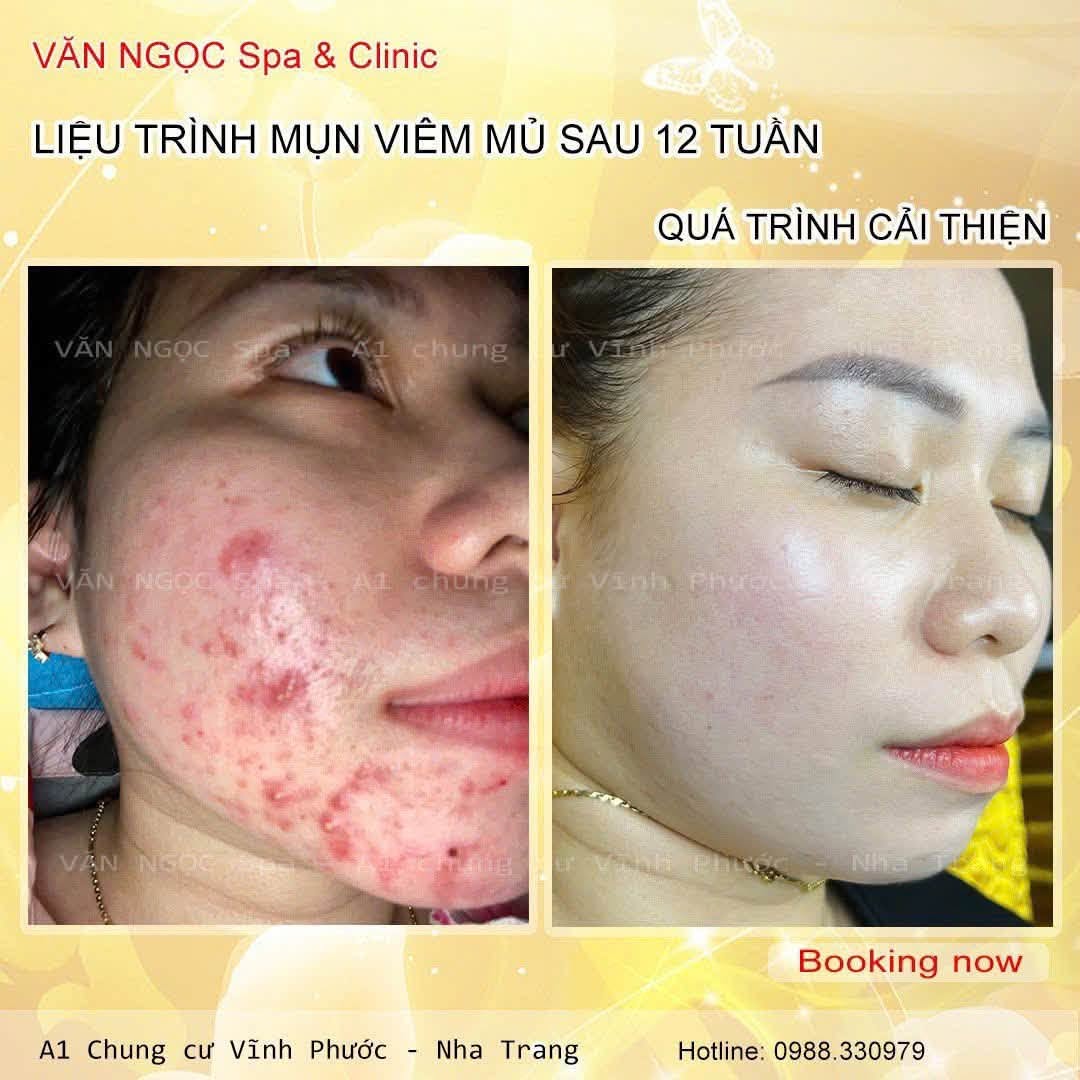 Hình ảnh nền da cần chăm sóc mụn và phục hồi tại Văn Ngọc Spa