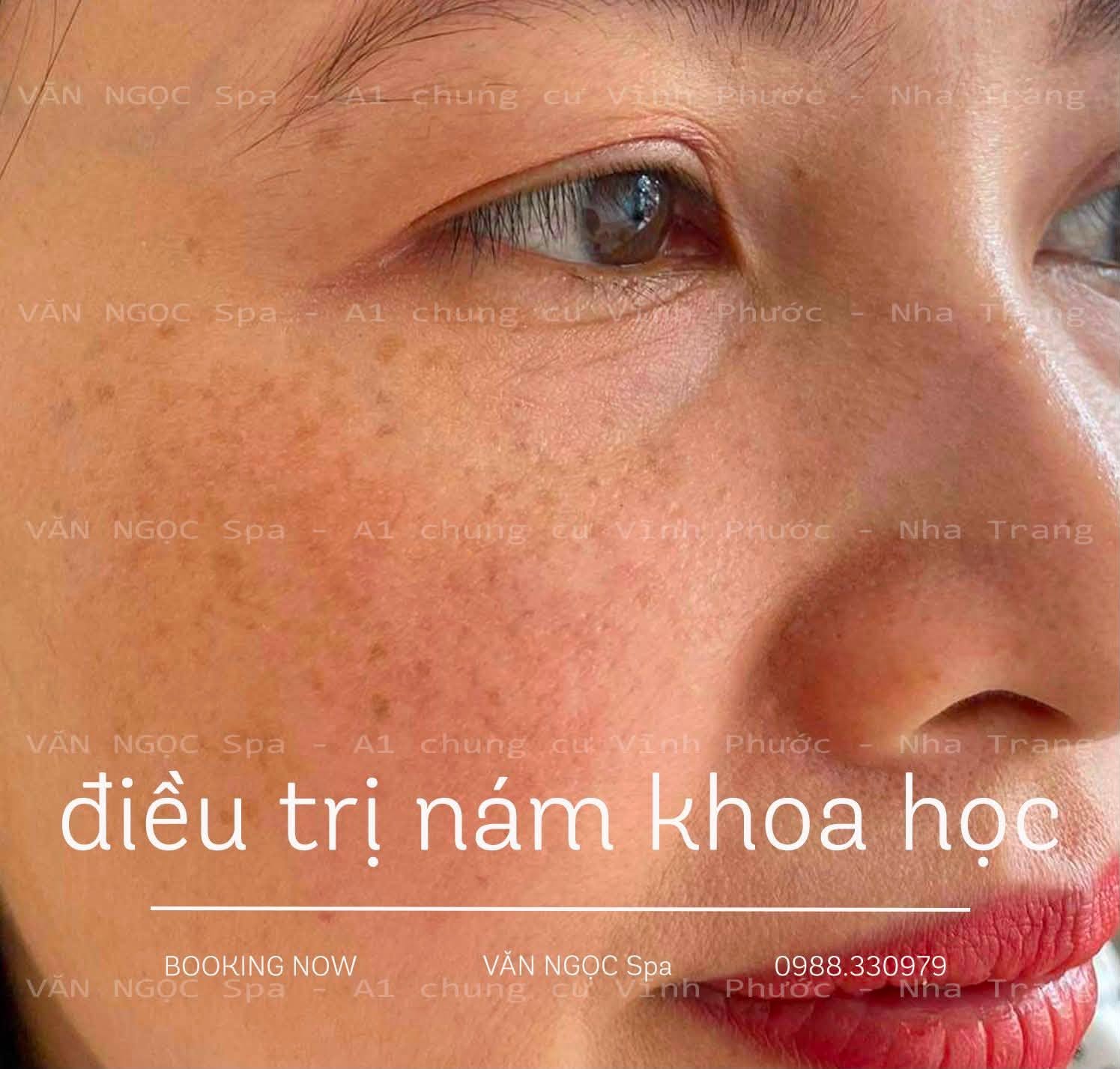 Hình ảnh làn da trong liệu trình chăm sóc sắc tố tại Văn Ngọc Spa