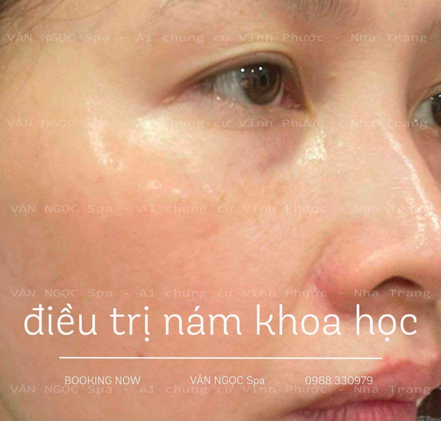 Hình ảnh theo dõi làn da trong liệu trình chăm sóc nám tại Văn Ngọc Spa