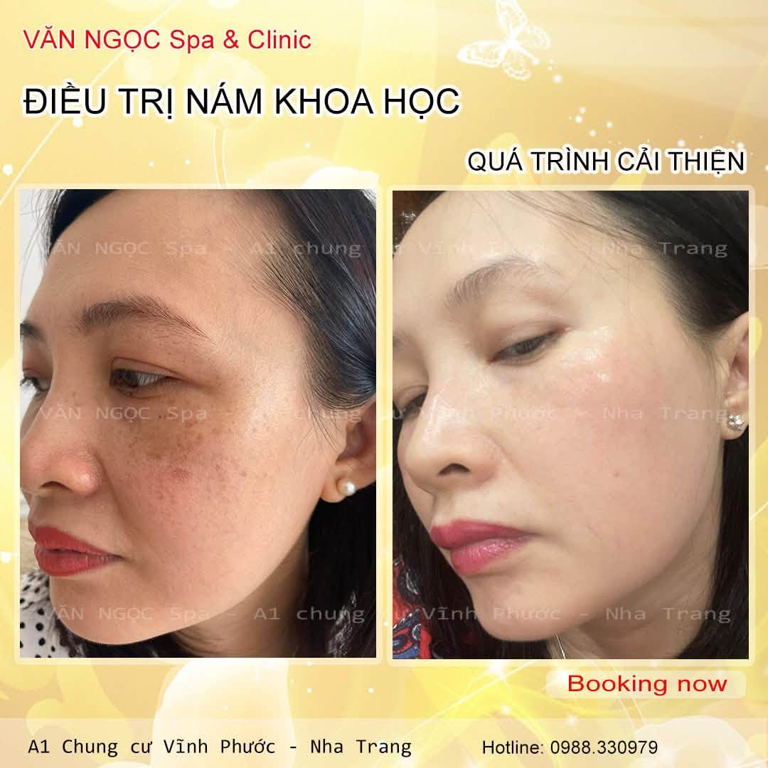Hình ảnh đối chiếu làn da trong quá trình chăm sóc sắc tố tại Văn Ngọc Spa