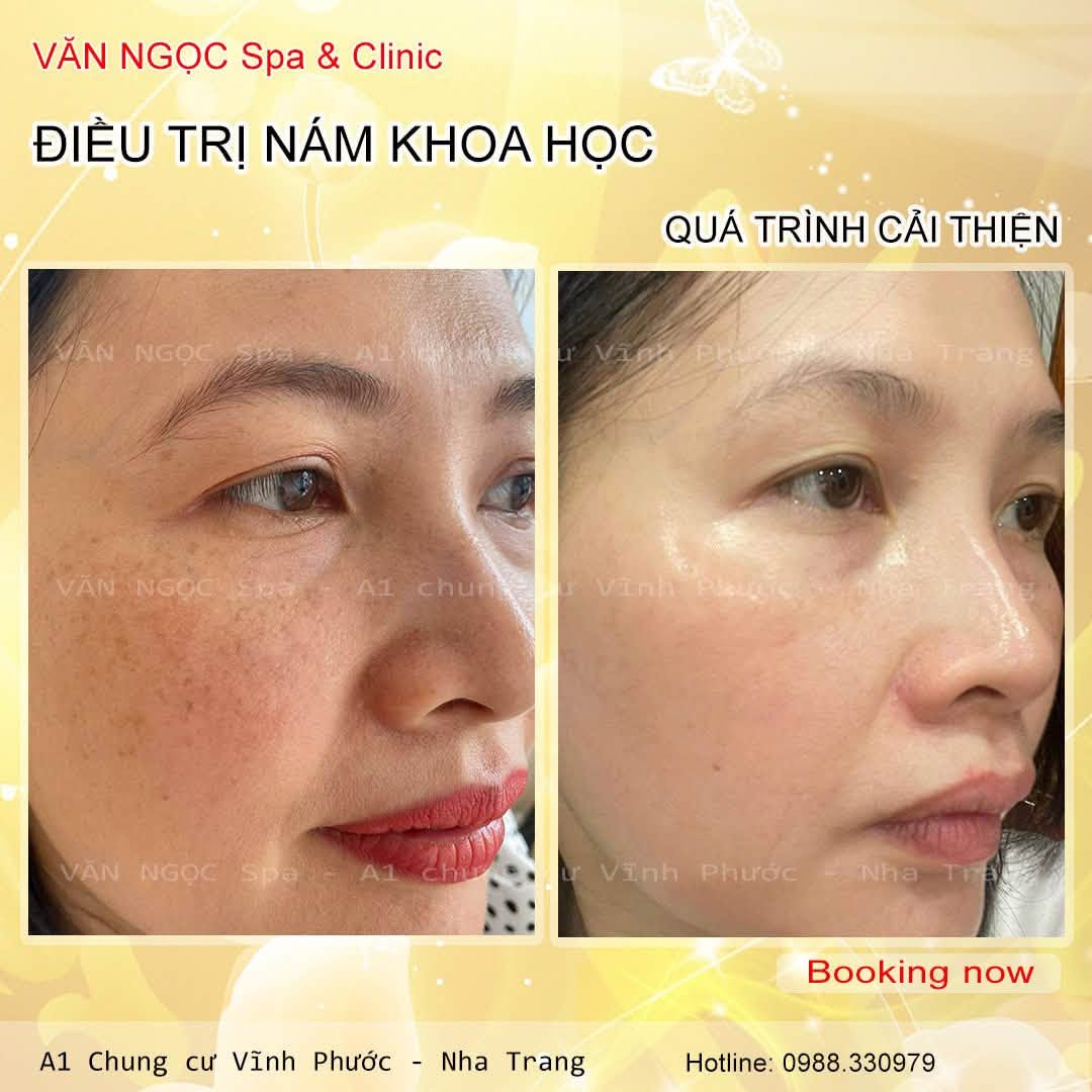 Hình ảnh làn da được theo dõi trong quá trình chăm sóc tại Văn Ngọc Spa