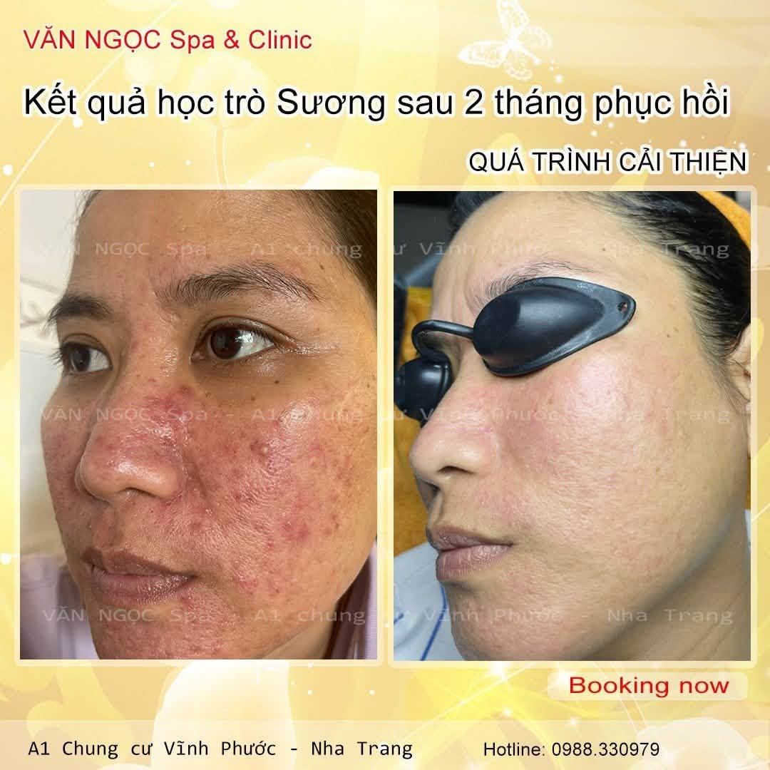 Hình ảnh đối chiếu nền da trong quá trình phục hồi tại Văn Ngọc Spa