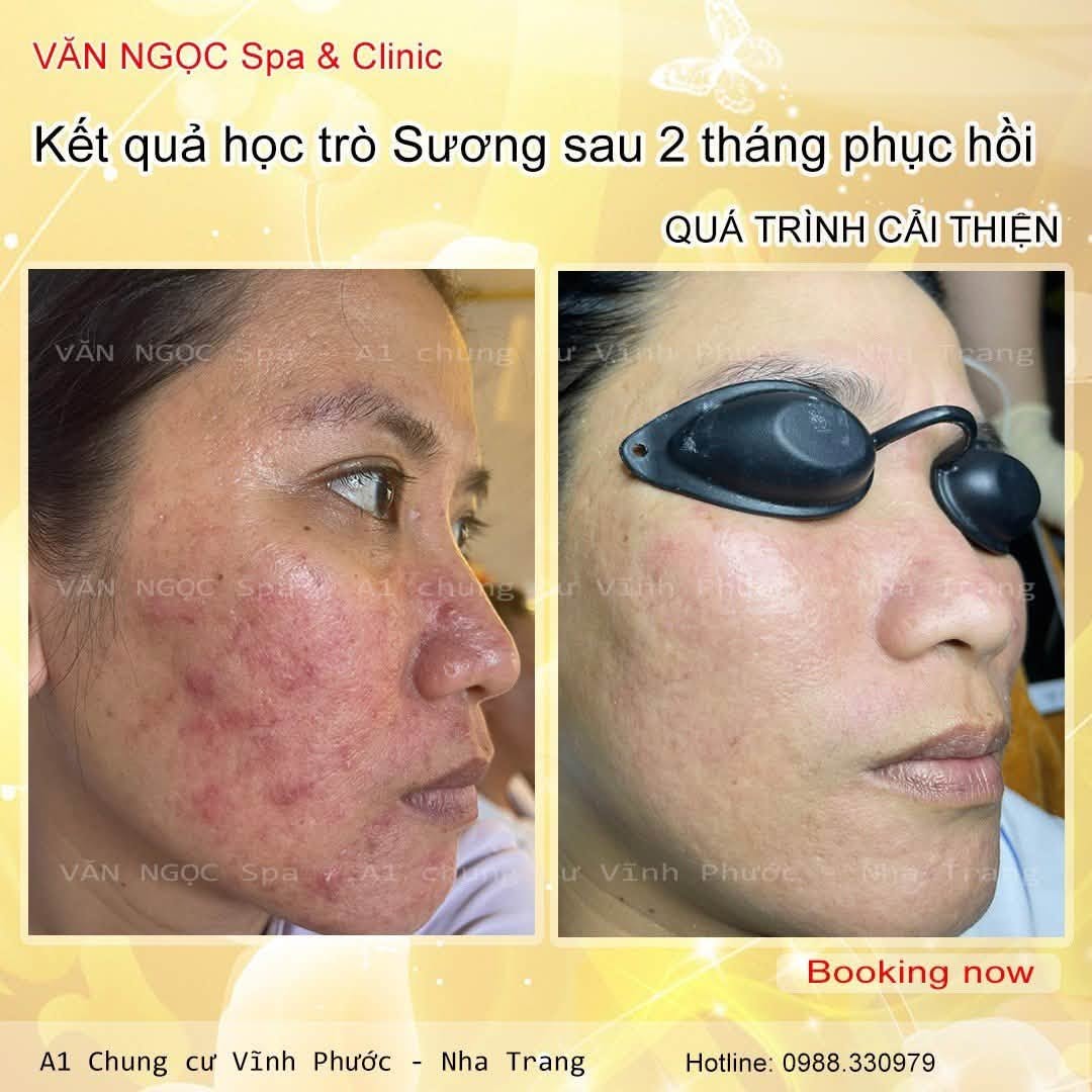 Hình ảnh theo dõi bề mặt da trong liệu trình phục hồi tại Văn Ngọc Spa