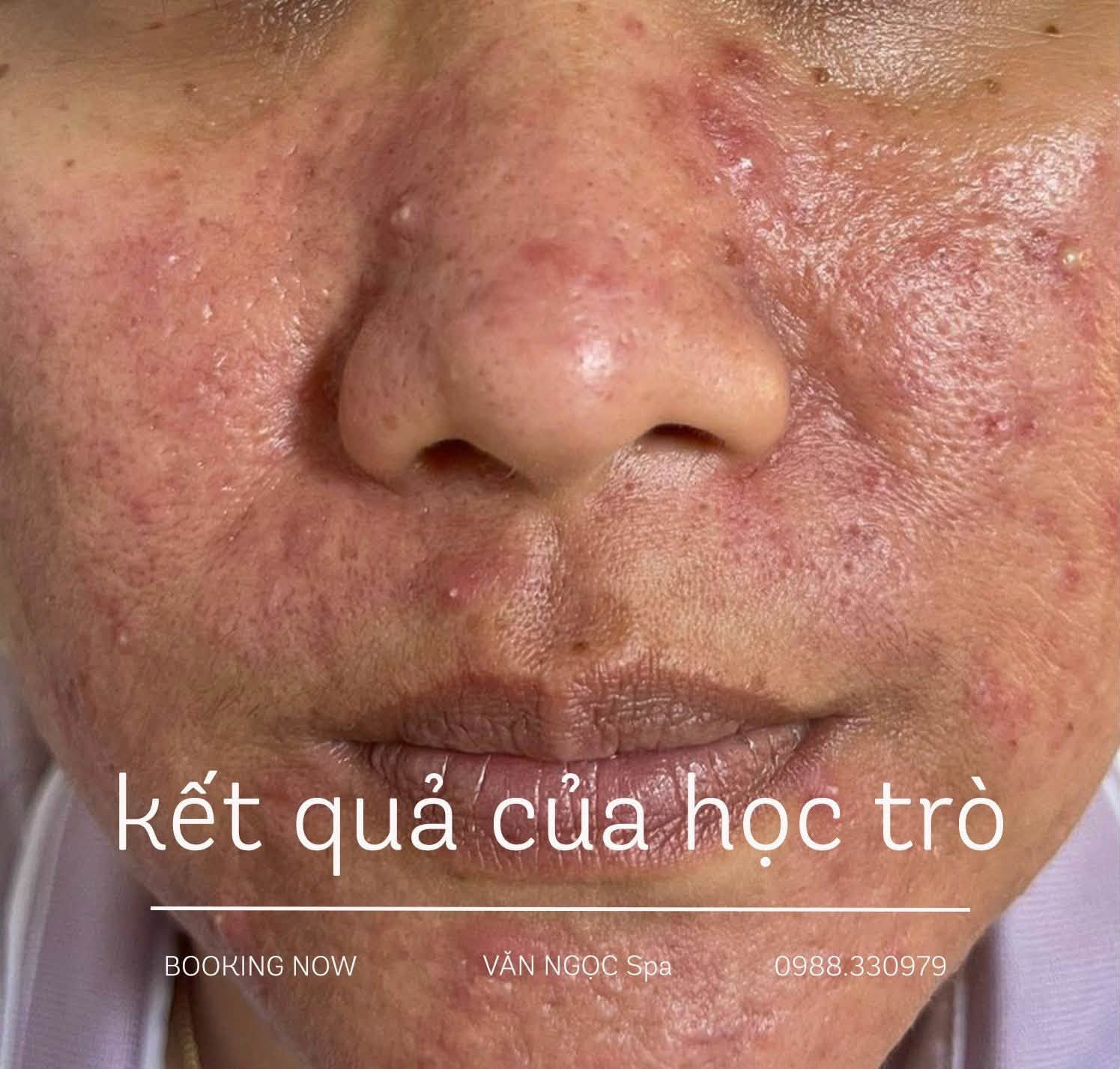 Hình ảnh nền da cần chăm sóc mụn và phục hồi tại Văn Ngọc Spa