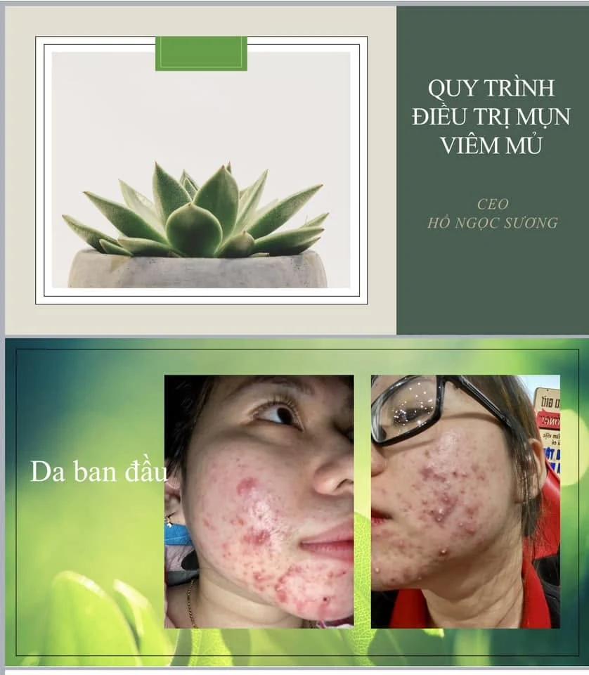 Hình ảnh nền da cần chăm sóc mụn và phục hồi tại Văn Ngọc Spa