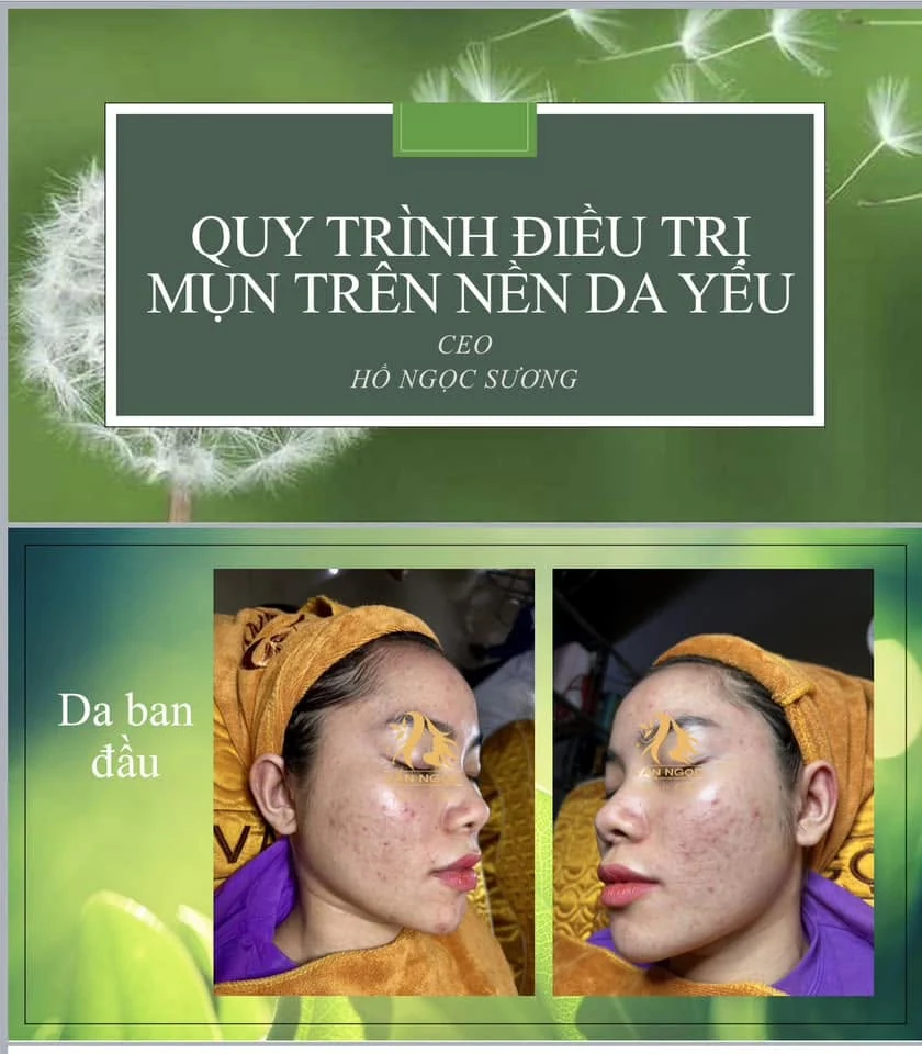 Hình ảnh đối chiếu nền da trong quá trình phục hồi tại Văn Ngọc Spa