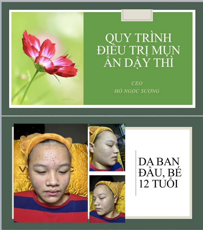 Hình ảnh theo dõi bề mặt da trong liệu trình phục hồi tại Văn Ngọc Spa