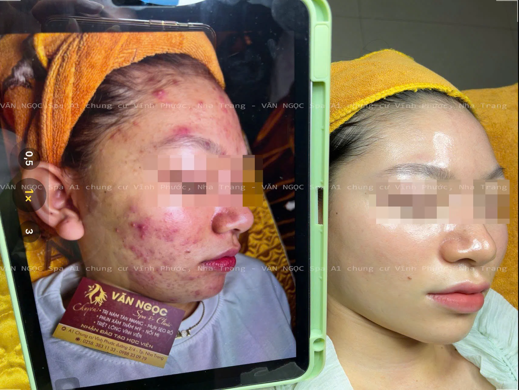 Hình ảnh theo dõi nền da mụn trước và sau quá trình chăm sóc tại Văn Ngọc Spa