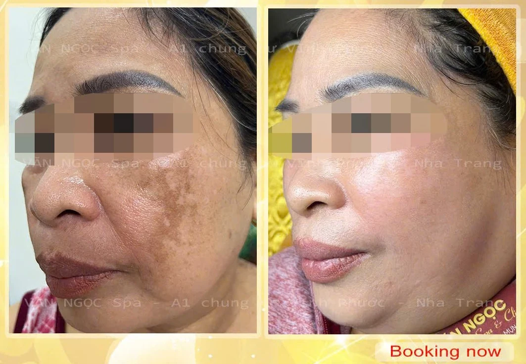 Hình ảnh theo dõi nền da nám và tàn nhang trong quá trình chăm sóc tại Văn Ngọc Spa