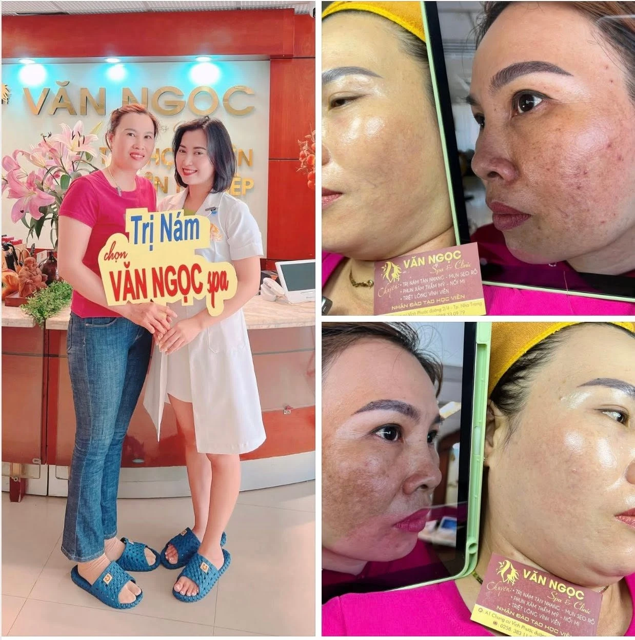 Hình ảnh theo dõi làn da trong liệu trình chăm sóc nám tại Văn Ngọc Spa